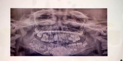 В Індії у семирічного хлопчика знайшли 526 зайвих зубів
