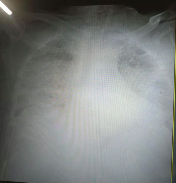 легені хворого на коронавірус фото з ФБ