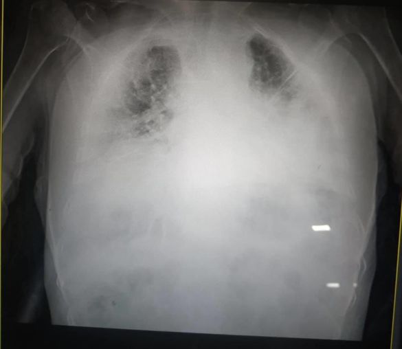 легені хворого на коронавірус фото з ФБ