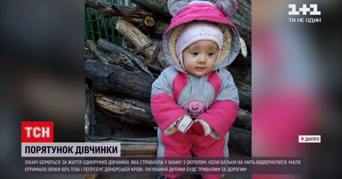 Медикаментозный сон и 60% ожогов кожи: в Днепре медики спасают годовалую девочку