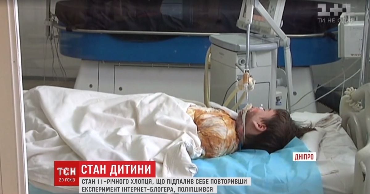 Медики розповіли про стан 11-річного хлопця, який підпалив себе заради відеоролику