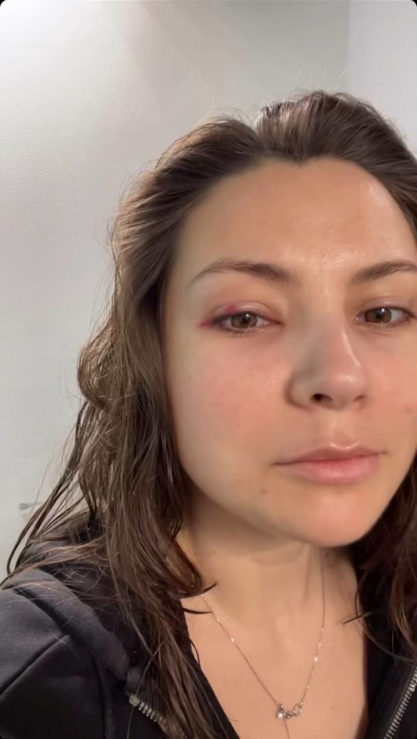 Антонина Хижняк повредила глаз / © instagram.com/tonya_actress