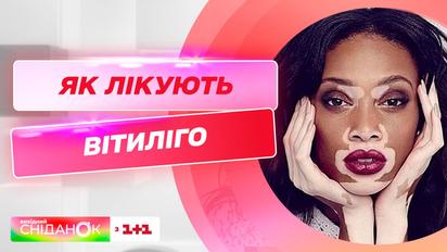 Болезнь Майкла Джексона или витилиго: как живут люди с таким диагнозом