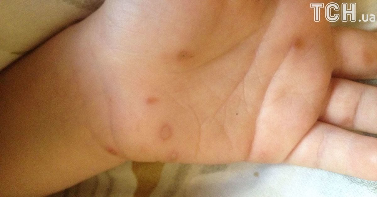 "Это вирус Коксаки". Родители бьют тревогу из-за заражения детей в киевском детсаду