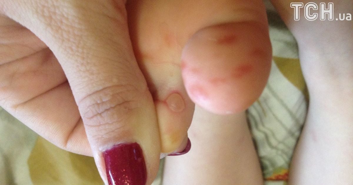 вірус коксакі у києві_3