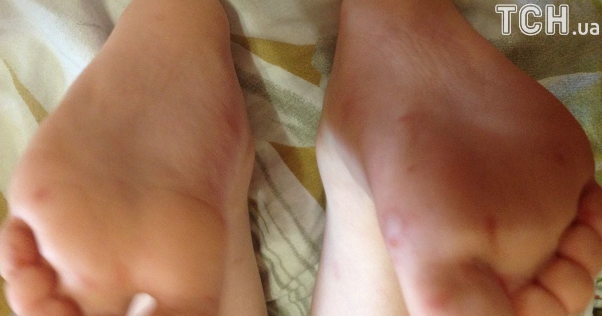 вірус коксакі у києві_2