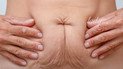 Как избавиться от дряблости кожи после похудения: советы от пластического хирурга