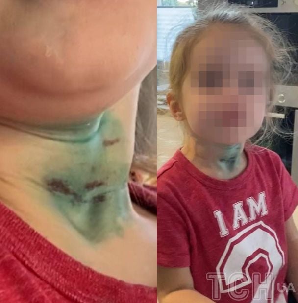 Травмы и ссадины на шее ребенка в садике замазали зеленкой