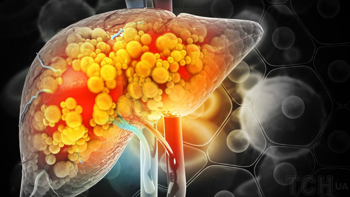 Основные симптомы жировой дистрофии печени на начальной стадии заболевания — клиника «Добробут»