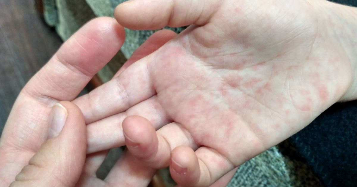 У Києві стався спалах кору: інфекцію виявили у школі, відділенні психіатрії та фармкомпанії