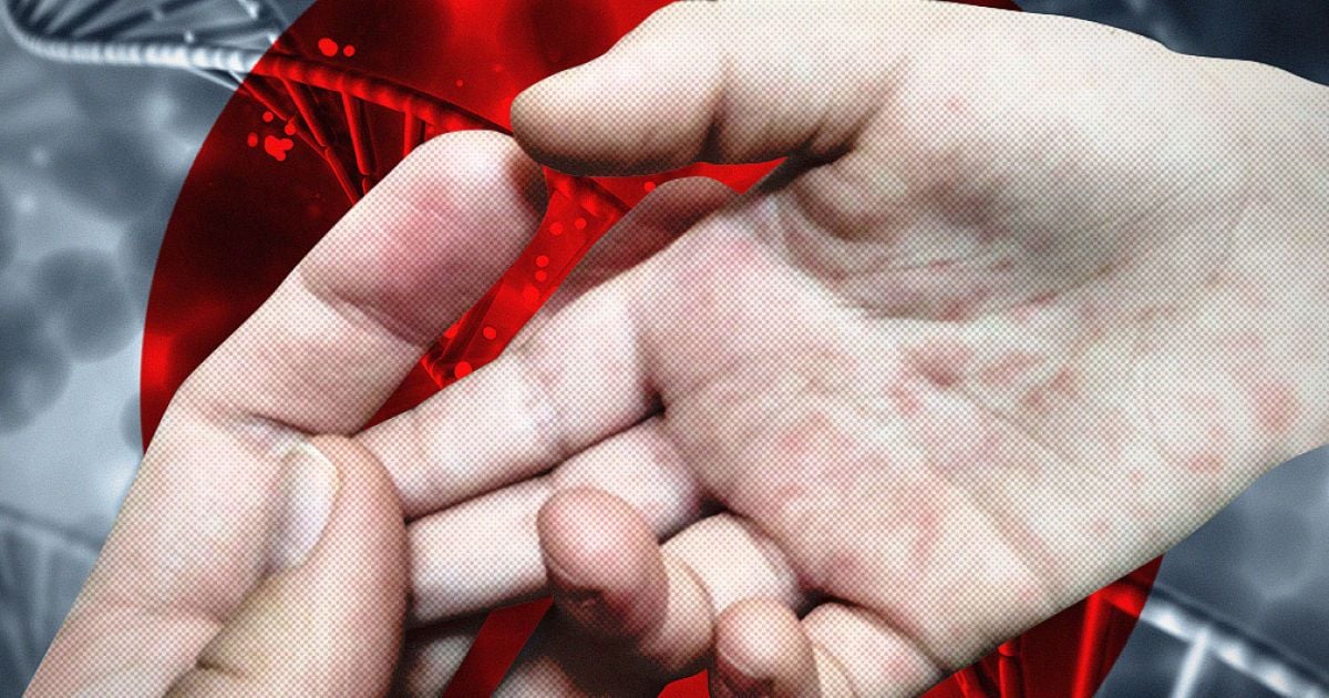 Перший випадок в місті: у Києві від кору померла людина