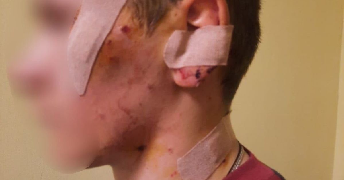 Під Києвом 17-річний хлопець підірвався на розтяжці