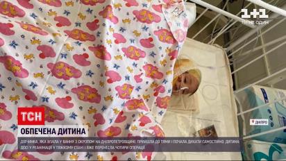 Новости Украины: девочка, которая упала в ванну с кипятком, пришла в себя и начала дышать