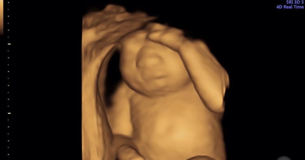 УЗД плоду Кері Янг