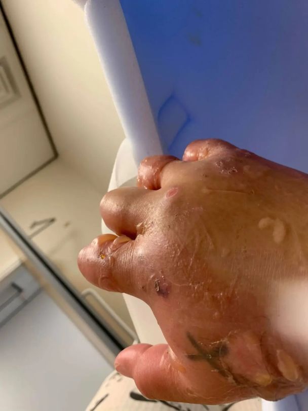 Її пальці так набрякли, що медикам довелося зрізати каблучки / © nypost.com