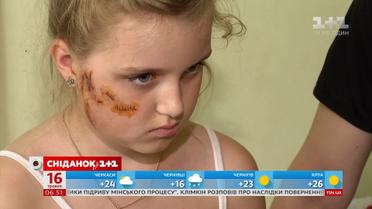 Сім годин без медичної допомоги: на Київщині дитину покусав вуличний собака