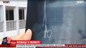Вьетнамец прожил 18 лет с ножницами в животе