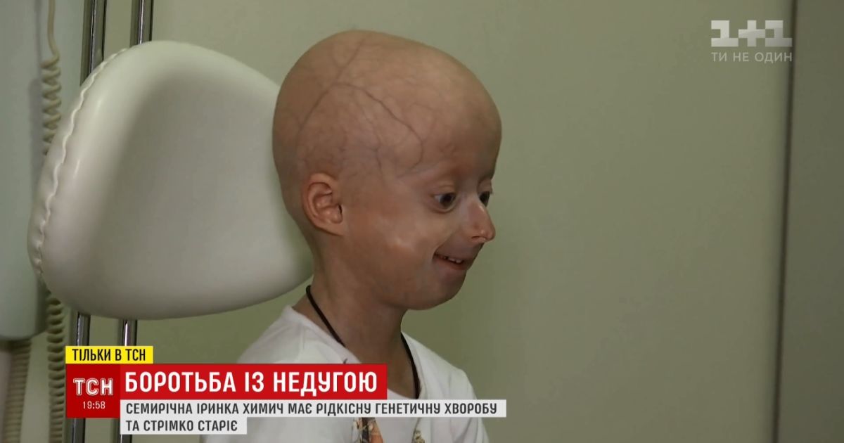 Украинские медики провели уникальную операцию девочке, организм которой стремительно постарел до 60-летнего возраста