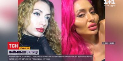 Украинка стала обладательницей самых больших скул в мире