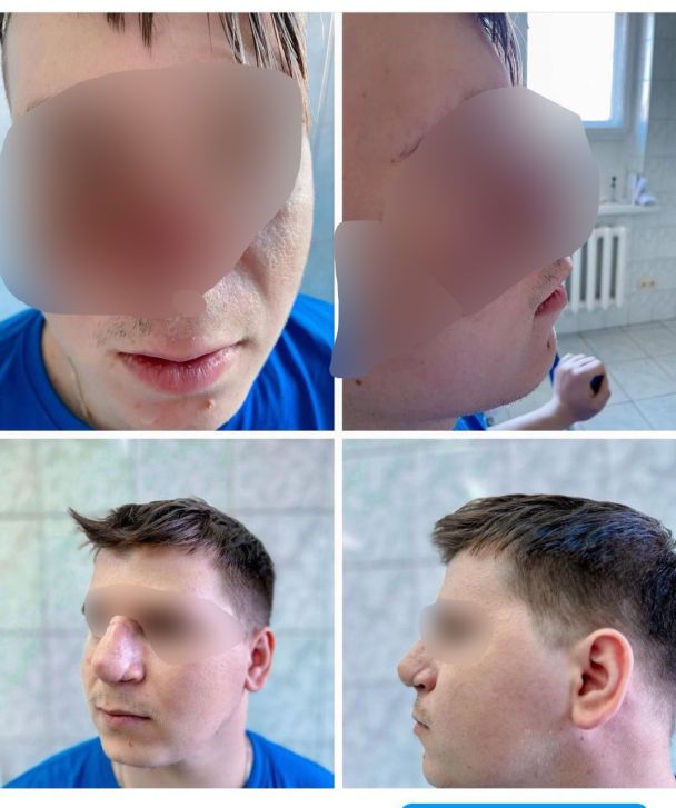 Військовий до та після операції. Фото надано О.Васильєвим.