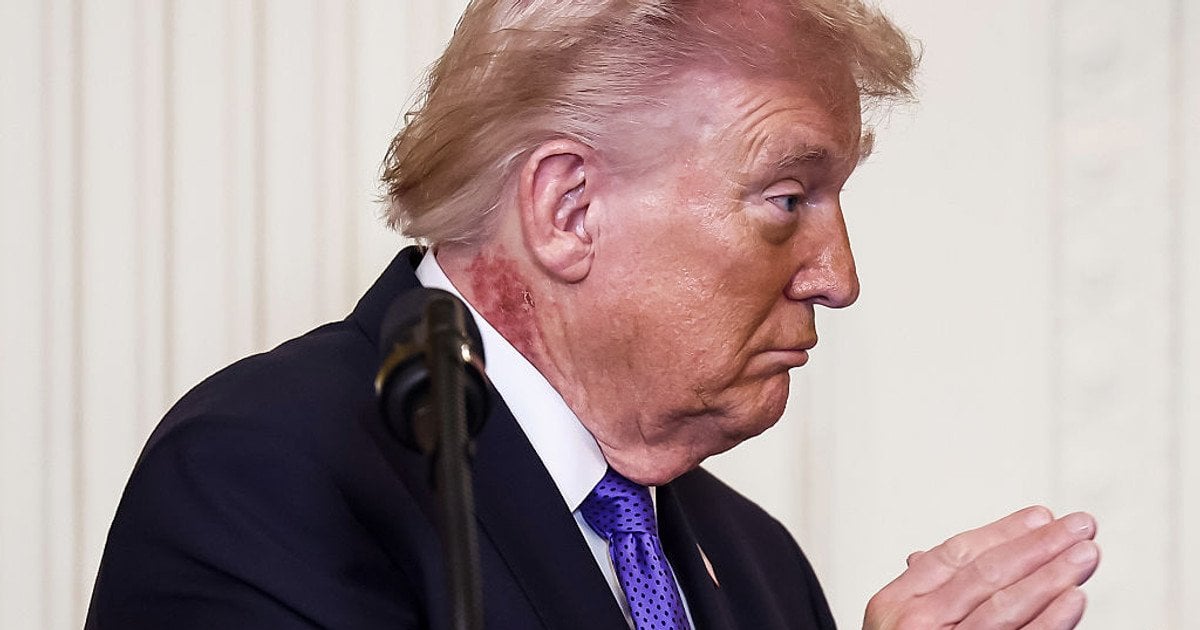 Президент США Дональд Трамп з висипом на шиї