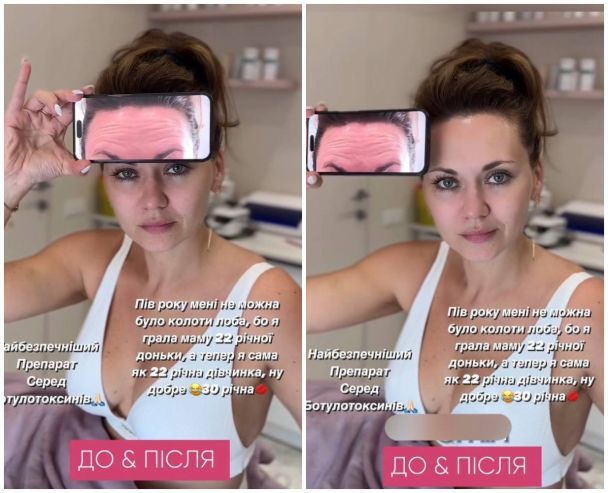 Анна Саливанчук уколола ботокс / © instagram.com/salivanchuk.anna