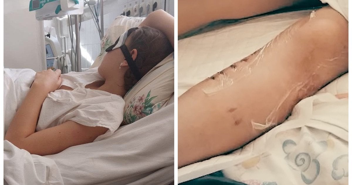 На Дніпропетровщині дівчинці ампутували ногу після нападу собаки