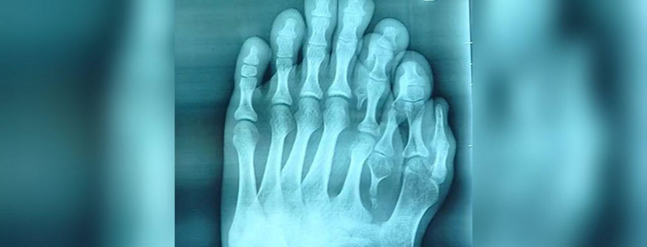 В Китае хирурги удалили лишние пальцы на ноге 21-летнего парня