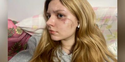 Сліди війни на обличчях українців - як хірурги рятують знівечені осколками тканини