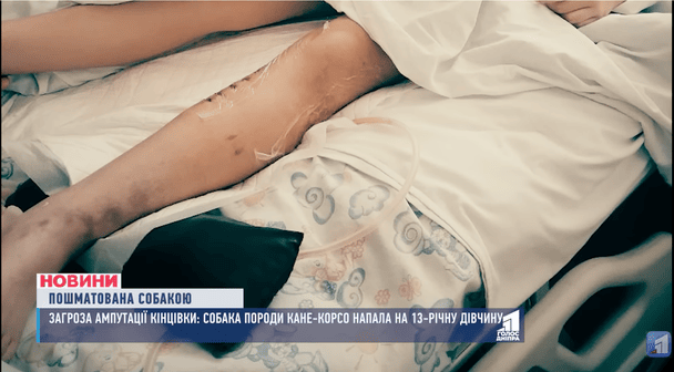 Покусуна нога дівчинки до ампутації / © Скриншот з відео «11 каналу»