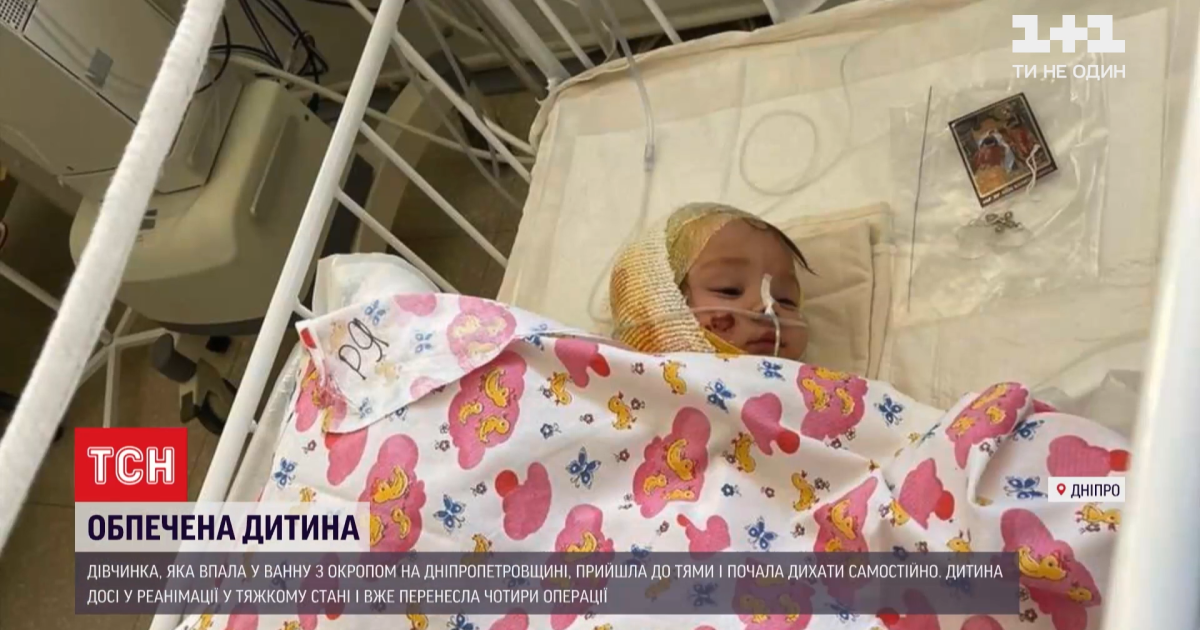 Залезла в ванну с кипятком: стало известно, как сейчас чувствует себя однолетняя Надежда из Марганца