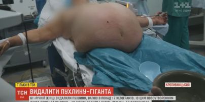17-кілограмову пухлину видалили пацієнтці в Кропивницькому
