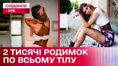 Дві тисячі родимок по всьому тілу: Історія українки Юліанни Юссеф