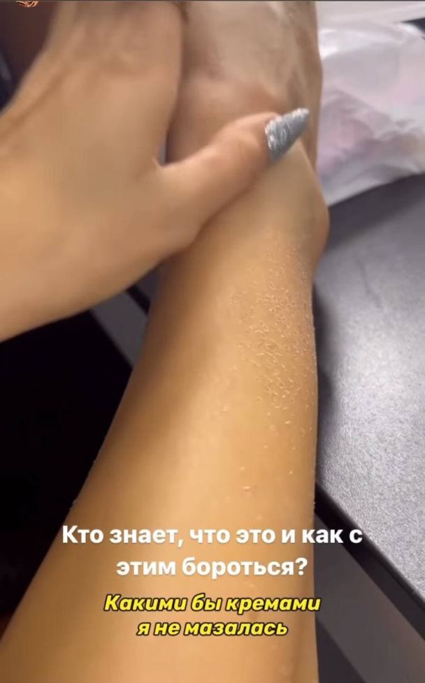 Анна Трінчер показала дивне висипання на шкірі / © instagram.com/annatrincher_official