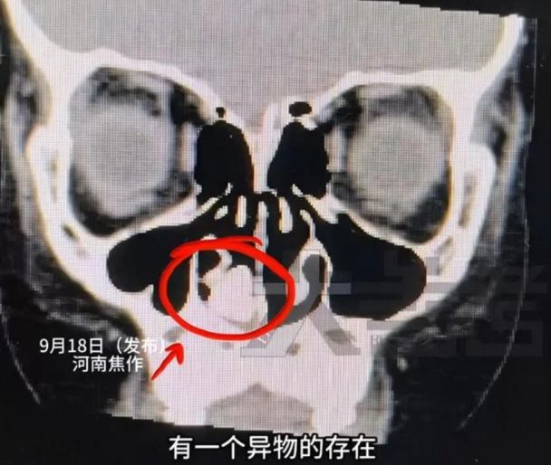 У носі дитини застряг металевий гвинт / Фото: Elephant News У носі дитини застряг металевий гвинт / Фото: Elephant News