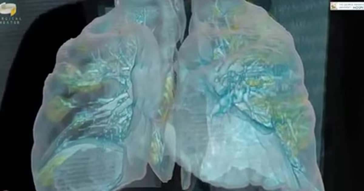 Что делает с легкими новый коронавирус: медики показали жуткое видео одного из пациентов