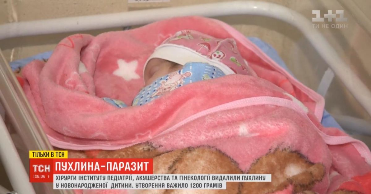 Столичные врачи удалили новорожденной девочке опухоль, которая весила почти половину ребенка