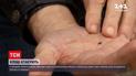 Новости Украины: чем опасны клещи