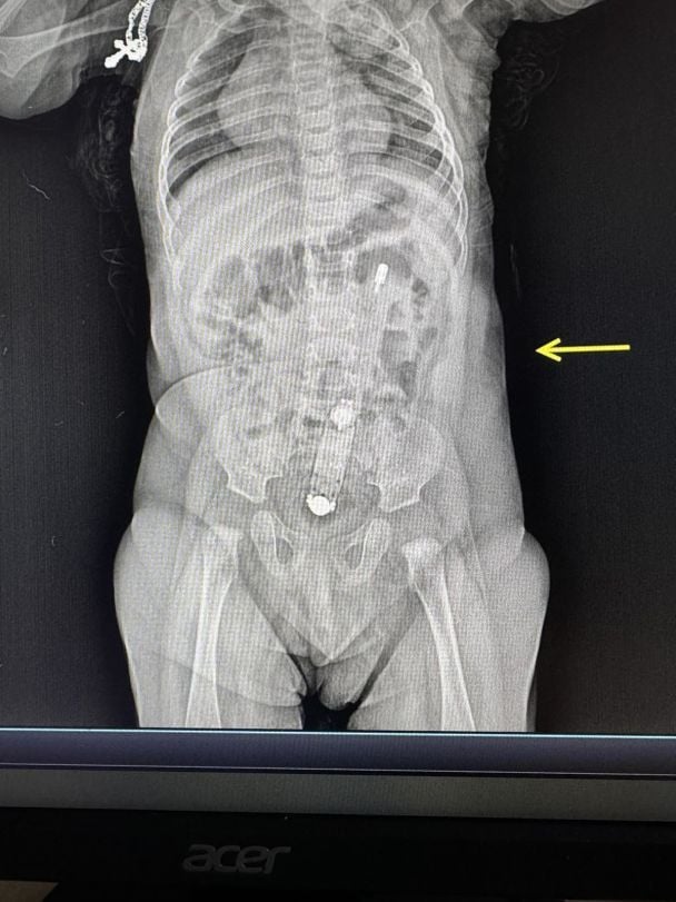 На рентгене был четко виден термометр, также он пальпировался из-за живота/Фото: Волынская областная детская клиническая больница