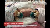 Хирурги США провели 11-часовую операцию, чтобы разделить сиамских близнецов