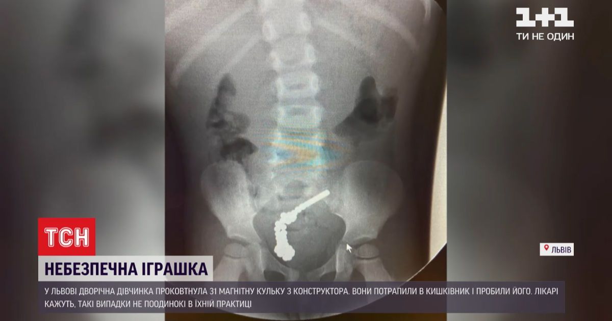 Маленьку львів'янку ледь не вбила популярна іграшка