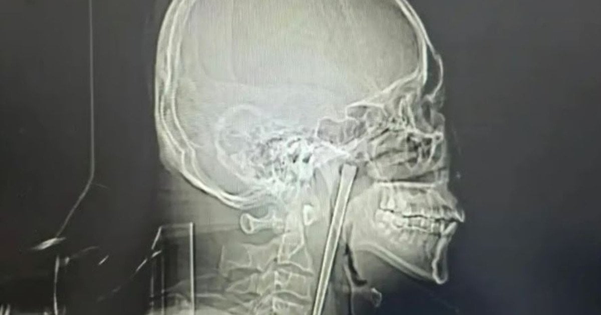 Металева паличка у горлі чоловіка