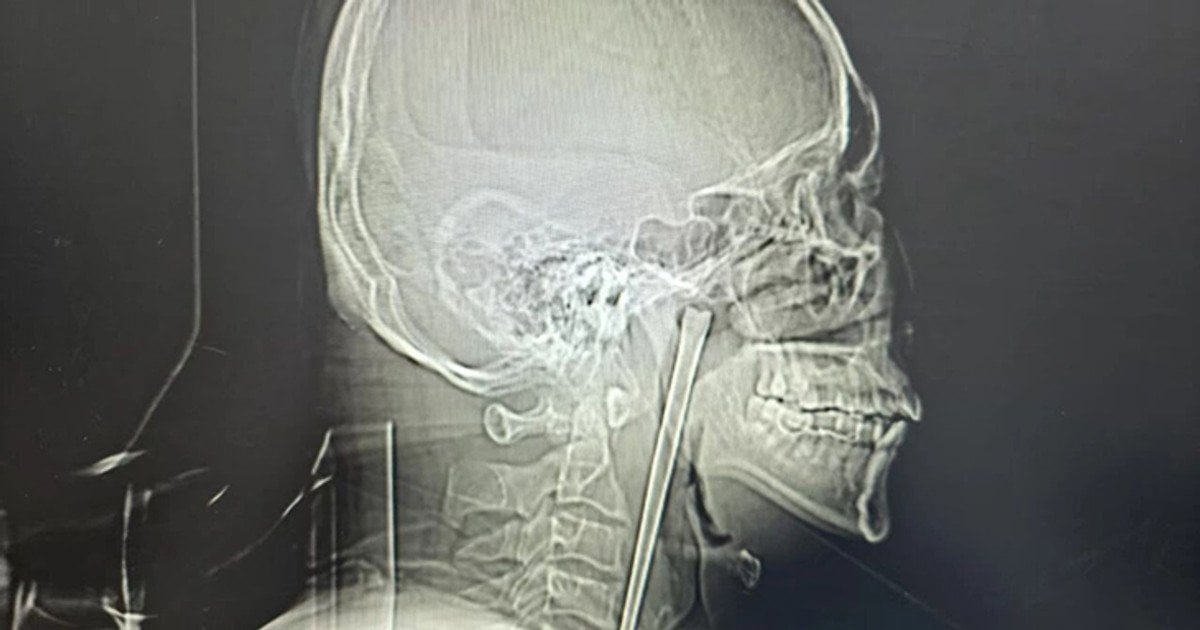 Человек 8 лет жил с металлической палочкой в горле