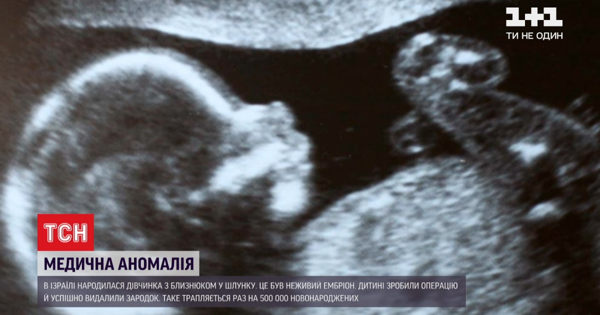 Ембріон мав серце та деякі кістки: в Ізраїлі народилася дівчинка з близнюком у шлунку