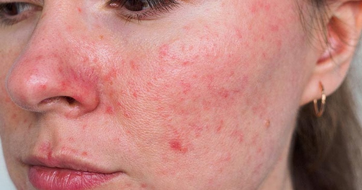 Розацеа / Фото: clevelandclinic.org