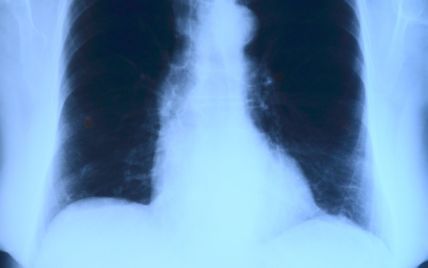 Чому для діагностики коронавірусу краще робити рентген легень: лікар-інфекціоніст пояснив деталі