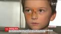 Домашний пес породы маламут укусил своего семилетнего хозяина за лицо