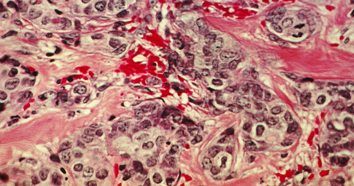 Раковые клетки молочной железы