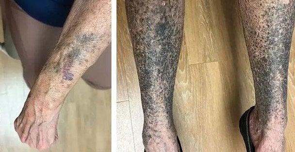 Руки та ноги жінки стали синьо-сірими через популярний антибіотик — фото