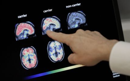 Болезнь Альцгеймера: причины и симптомы